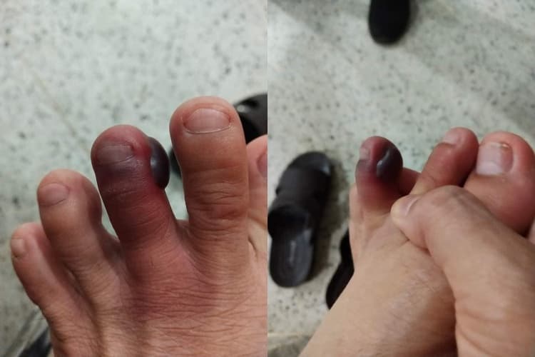 馬陸遭擠壓時會噴出具腐蝕性的毒液，造成皮膚灼傷。（翻攝自臉書）