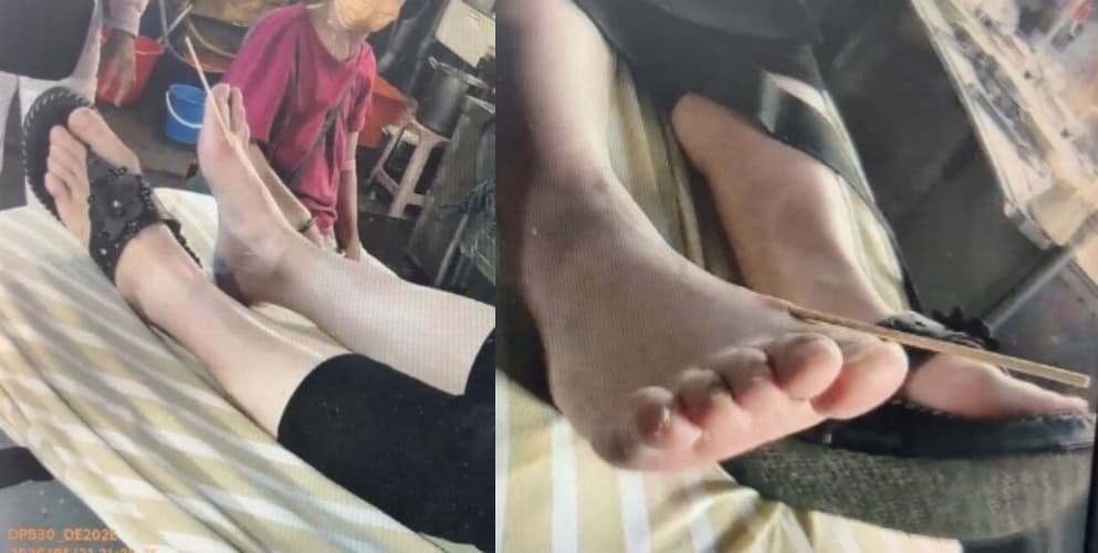 救護人員評估發現,竹籤疑似因受傷女子踩踏後翻轉,直接從上方刺入右腳腳背,現場血跡斑斑,目前已送往衛福部基隆醫院治療。(翻攝畫面)