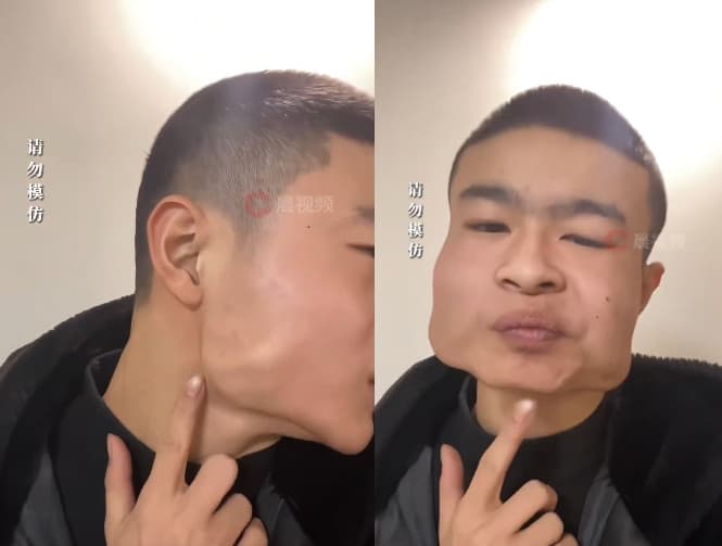 中國一名青少年因長期吃檳榔，導致臉變成方塊臉。（翻攝微博）