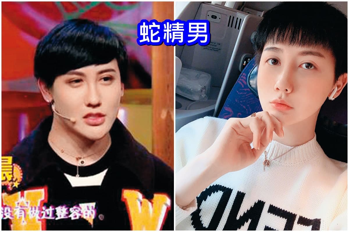 蛇精男只坦承自己打玻尿酸「微整」。(網路圖片)